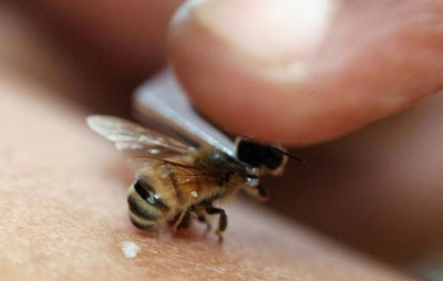 زنبور درمانی وخواص نیش زنبور عسل